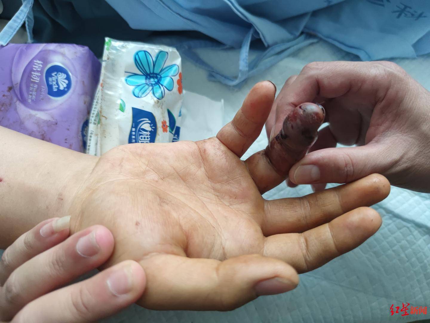 丹麦丙组联赛_男子被毒蛇咬伤拦车自救丹麦丙组联赛?当事人讲述:当时可能把手指直接伸向了蛇嘴里